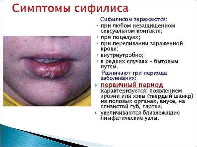 Сифилис: признаки, симптомы, диагностика и лечение