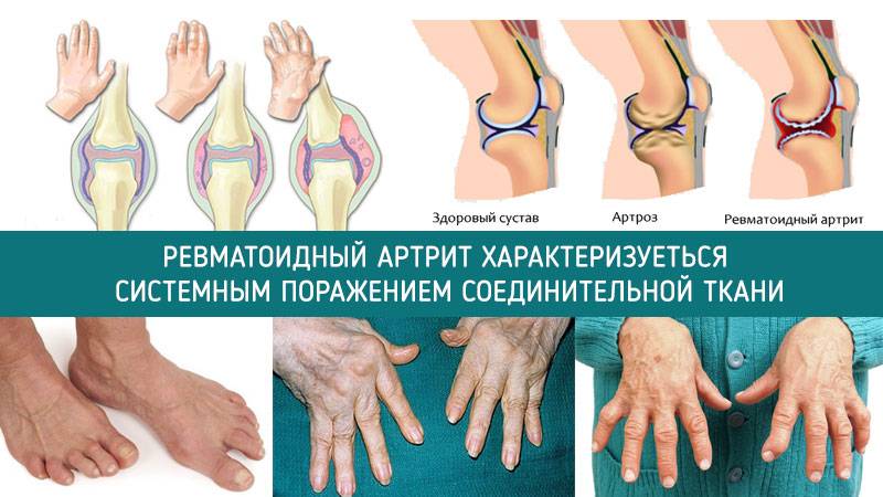 Болезнь суставов артрита