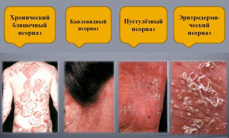 Берут ли с гепатитом с в армию, и как получить отсрочку