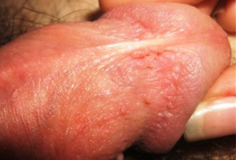 Penis Wart Picture