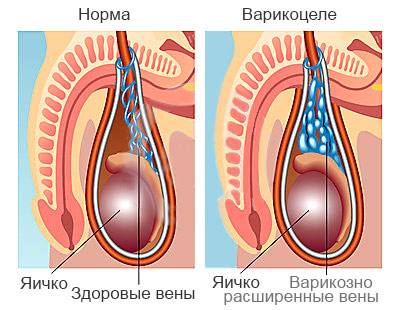 Методы оперирования при варикозе мошонки