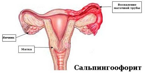 Боль внизу живота у мужчин слева