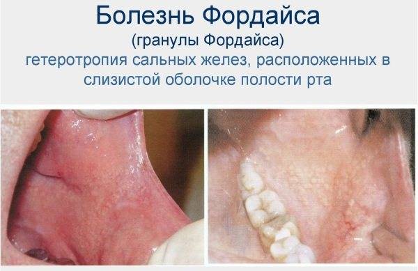Эффективные средства для устранения гранул фордайса