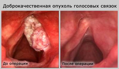Лечение папилломы в горле народными средствами