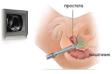 Как образуются и чем опасны кальцинаты в предстательной железе