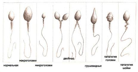 Какие болезни могут вызвать бесплодие у мужчин?