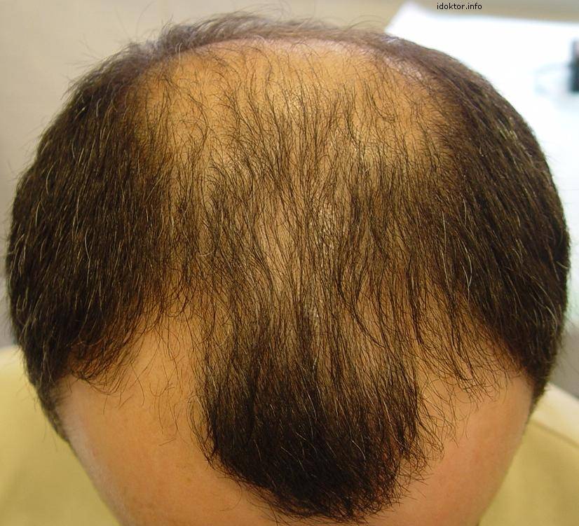Поврежденные волосы у мужчин