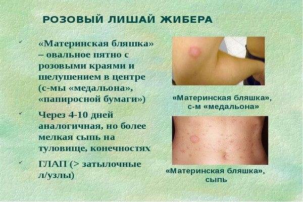 Прыщи по всему телу: причины и лечение