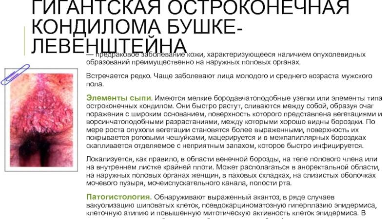 Опухоль бушке левенштейна: диагностика и лечение