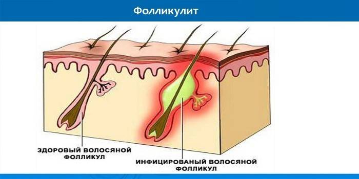 Подрывающий фолликулит гофмана: причины, симптомы и лечение