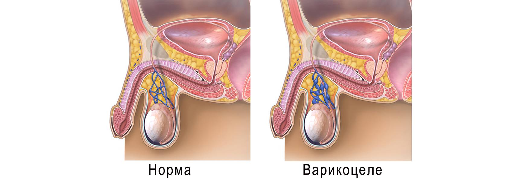 Варикоцеле медикаментозное лечение
