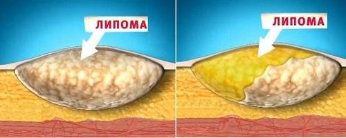 Вашу молодость и привлекательность портят жировики на лице? не беда — выход есть всегда или как избавиться от дефекта