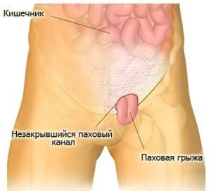 Особенности послеоперационного периода после удаления паховой грыжи