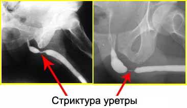 Сужение мочеиспускательного канала у мужчин причины