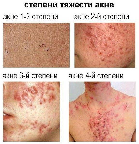 Распространенные кожные заболевания людей — фото и описания