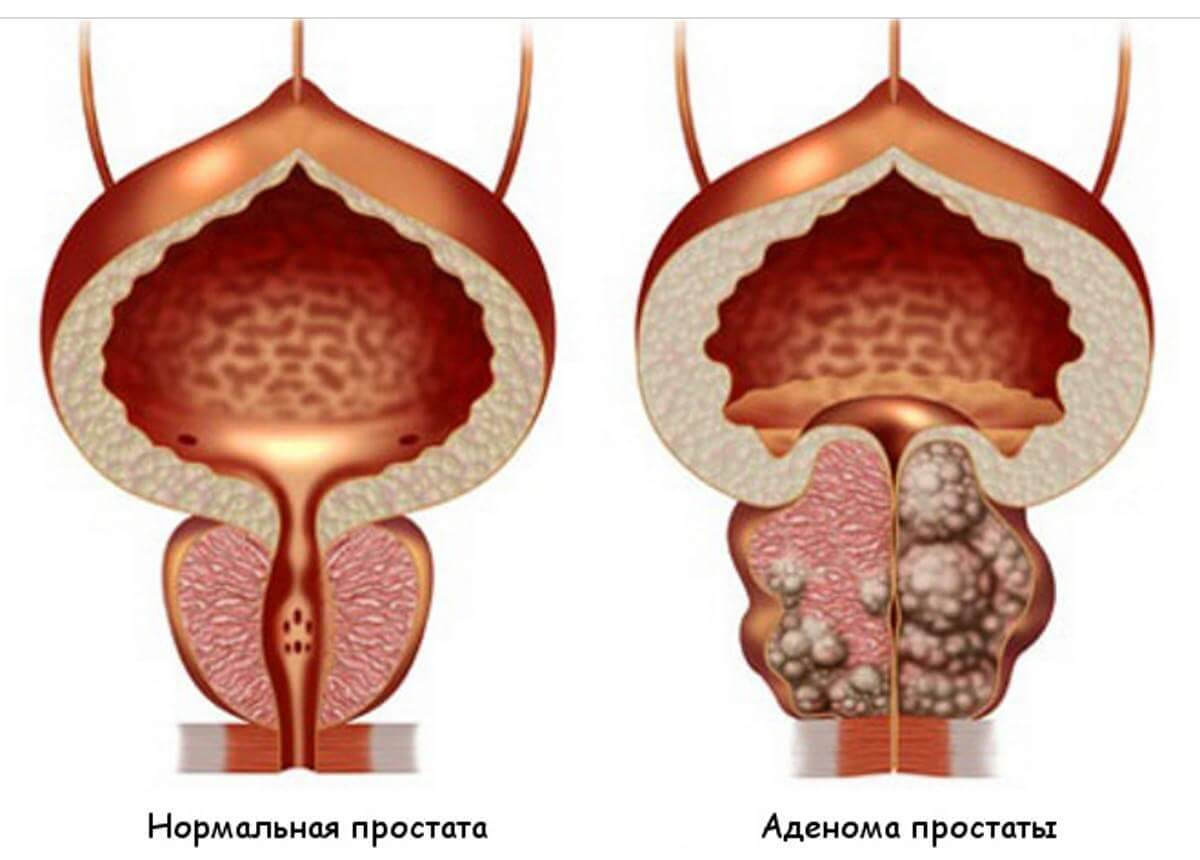 можно ли кончить при простатите фото 105