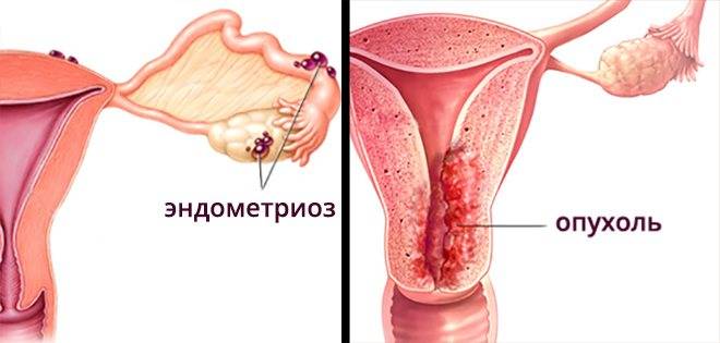 Гормон 17-он прогестерон повышен – что это значит?