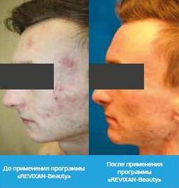 Лечение акне у взрослых и подростков: какие методы физиотерапии применяются