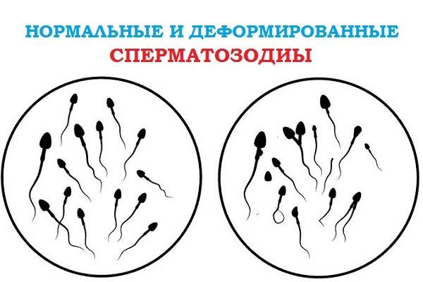 Тератозооспермия у мужчин: причины, лечение